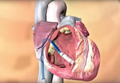 IMPLANTAN MARCAPASO EN UN BEBÉ PREMATURO